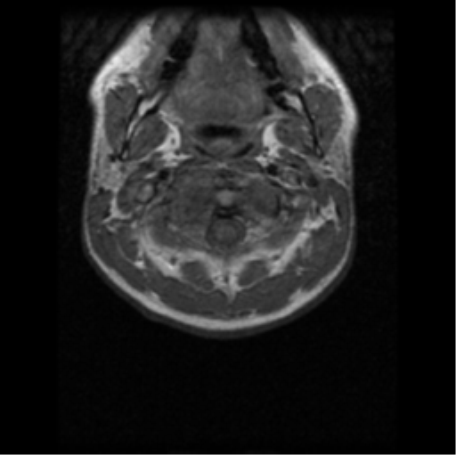 File:Cervical vertebrae metastasis (Radiopaedia 78814-91667 Axial T1 9).png