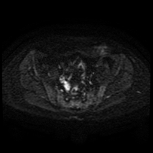 Cesarian section scar endometriosis (Radiopaedia 66520-75799 Axial DWI 57).jpg