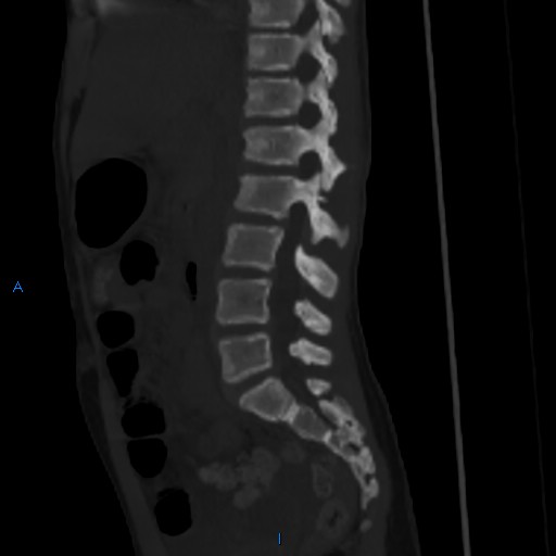 File:Chance fracture with duodenal and pancreatic lacerations (Radiopaedia 43477-50042 Sagittal bone window 13).jpg