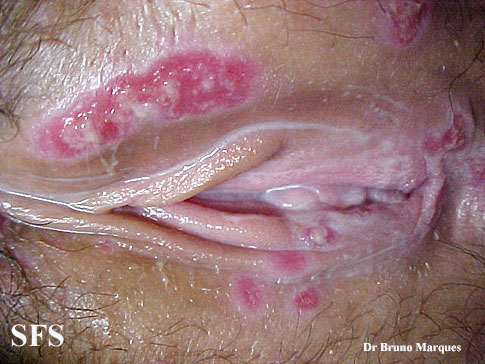 File:Chancroid (Dermatology Atlas 5).jpg