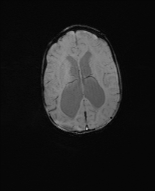 Chiari III malformation with occipital encephalocele (Radiopaedia 79446-92559 Axial SWI 41).jpg
