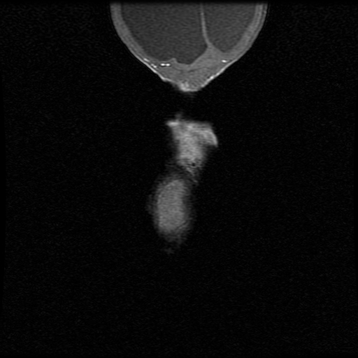 File:Chiari II malformation with spinal meningomyelocele (Radiopaedia 23550-23652 Coronal T1 11).jpg
