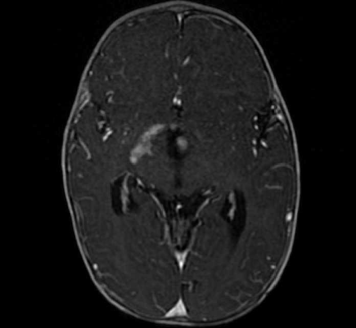 Chiasmatic-hypothalamic glioma (Radiopaedia 90079-107252 Axial T1 C+ 39).jpg