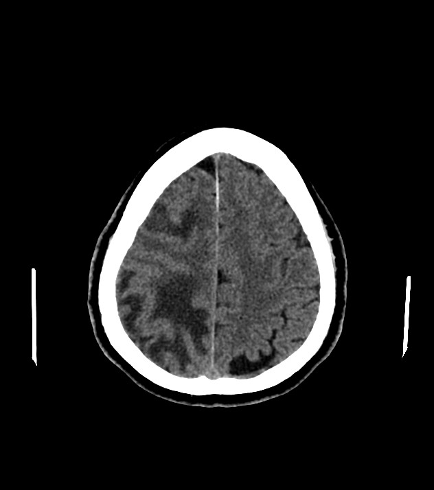 Cholangiocarcinoma with cerebral metastases (Radiopaedia 83519-98628 Axial non-contrast 52).jpg