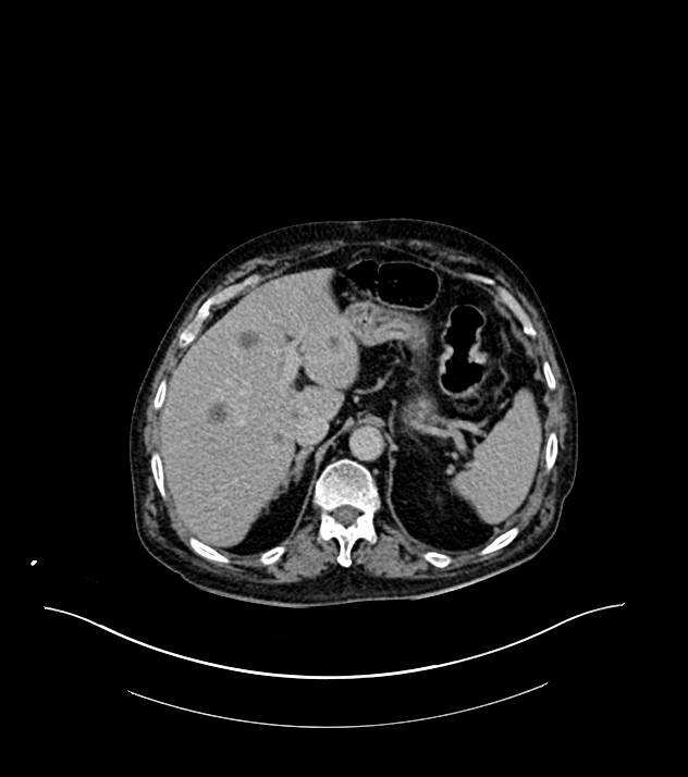Cholangiocarcinoma with cerebral metastases (Radiopaedia 83519-98629 Axial C+ delayed 24).jpg