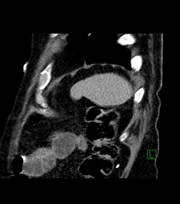 Cholangiocarcinoma with cerebral metastases (Radiopaedia 83519-98629 Sagittal C+ delayed 15).jpg