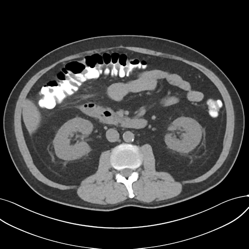 Cholecystitis with focal perforation and hepatic abscess (Radiopaedia 37189-38945 Axial non-contrast 39).png