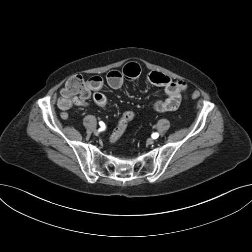 Cholecystoduodenal fistula due to calculous cholecystitis with gallstone migration (Radiopaedia 86875-103077 A 54).jpg