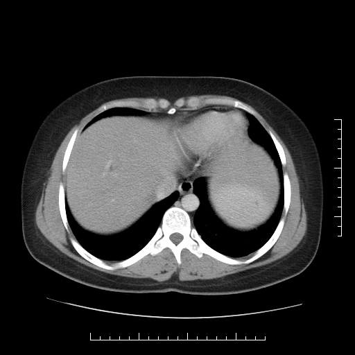 File:Choledochal cyst with chronic calcific pancreatitis (Radiopaedia 18245-18061 A 1).png