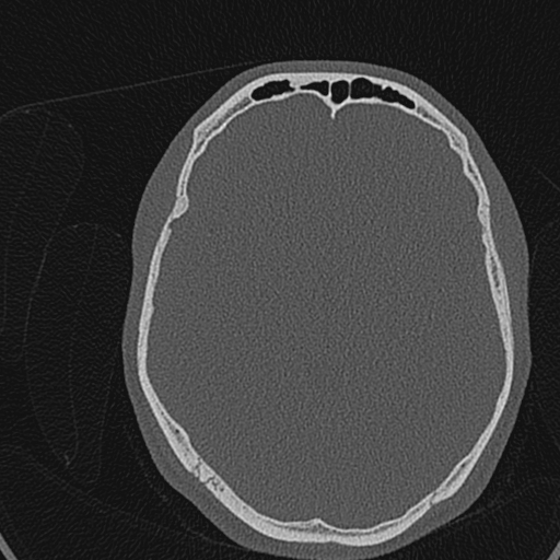 Cholesteatoma (Radiopaedia 70429-80529 Axial bone window 146).jpg
