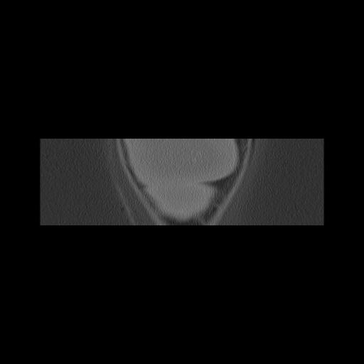 Cholesteatoma (Radiopaedia 84946-100455 Coronal bone window 180).jpg