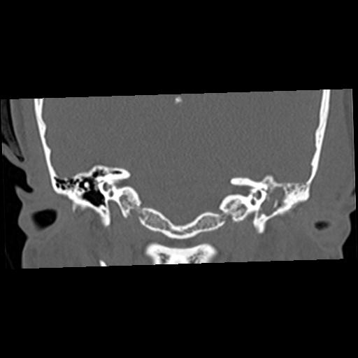 Cholesteatoma (Radiopaedia 84960-100474 Coronal bone window 31).jpg