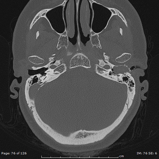 Cholesteatoma - external auditory canal (Radiopaedia 88452-105096 Axial bone window 39).jpg