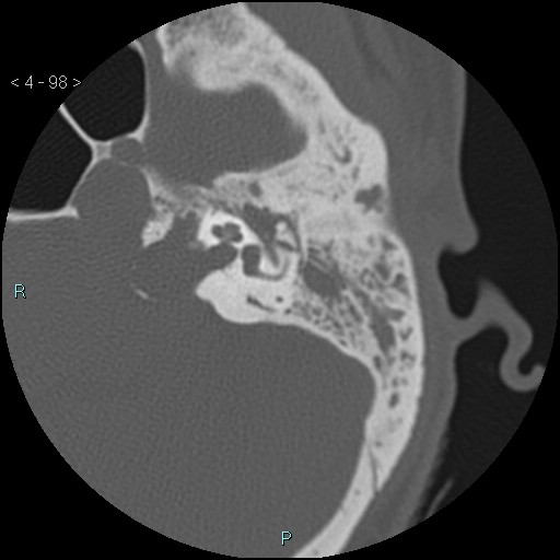 File:Cholesterol granuloma of the petrous apex (Radiopaedia 64358-73141 Axial bone window 48).jpg
