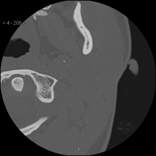 Cholesterol granuloma of the petrous apex (Radiopaedia 64358-73141 Axial bone window 99).jpg