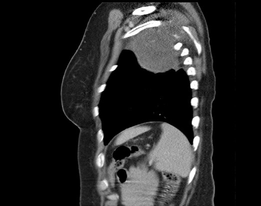 Chondrosarcoma - chest wall (Radiopaedia 65192-74199 B 13).jpg