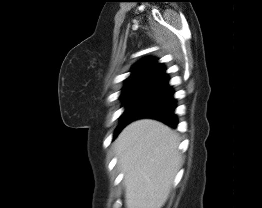Chondrosarcoma - chest wall (Radiopaedia 65192-74199 B 52).jpg