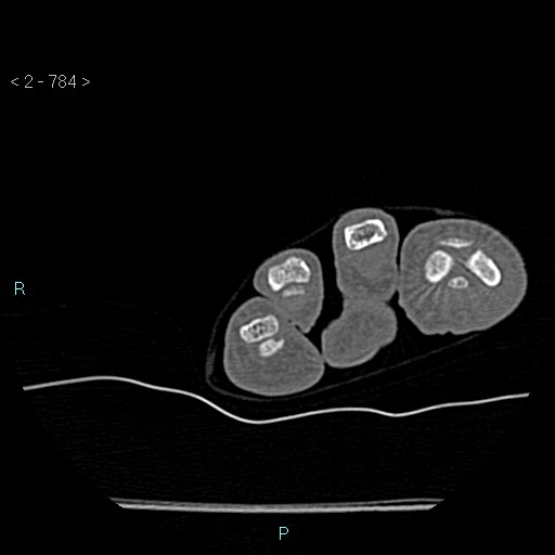 Chondrosarcoma - phalanx (Radiopaedia 69047-78812 Axial bone window 38).jpg