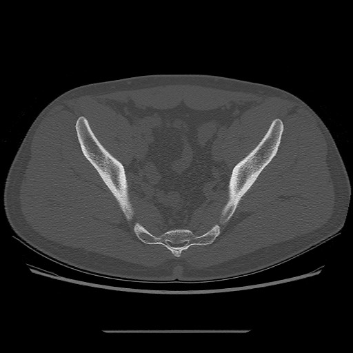 File:Chondrosarcoma of iliac wing (Radiopaedia 63861-72599 Axial bone window 77).jpg