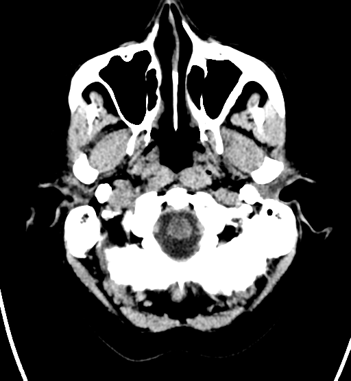 File:Chondrosarcoma of skull base- grade II (Radiopaedia 40948-43653 Axial non-contrast 2).png