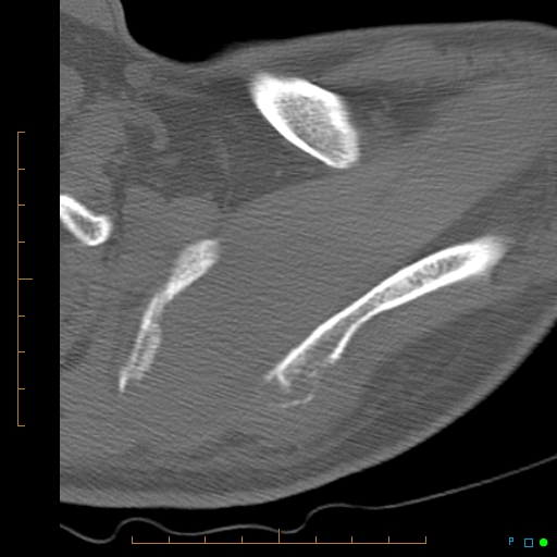 File:Chondrosarcoma of the scapula (Radiopaedia 30696-31399 Axial non-contrast 14).jpg