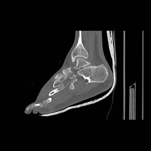File:Chopart fracture (Radiopaedia 12386-12650 Sagittal bone window 19).jpg