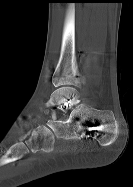 Chopart fracture (Radiopaedia 35347-36861 Sagittal bone window 48).jpg
