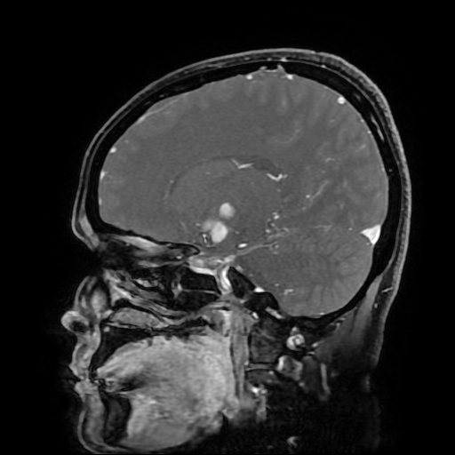 Chordoid glioma of third ventricle (Radiopaedia 91612-109340 F 89).jpg
