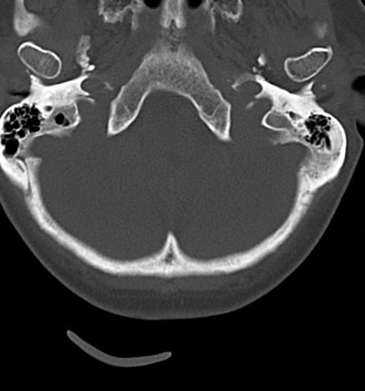File:Chordoma (C4 vertebra) (Radiopaedia 47561-52188 Axial bone window 1).png