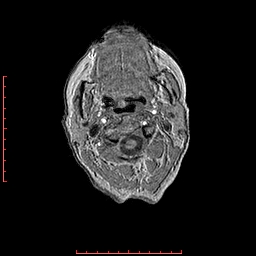 File:Choroid plexus xanthogranuloma (Radiopaedia 67843-77270 Axial T1 173).jpg