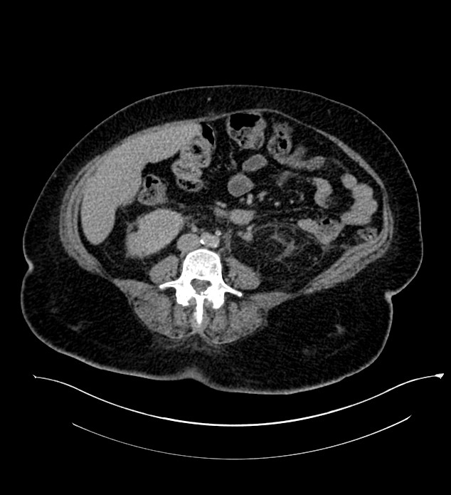 Chromophobe renal cell carcinoma (Radiopaedia 84239-99519 E 94).jpg