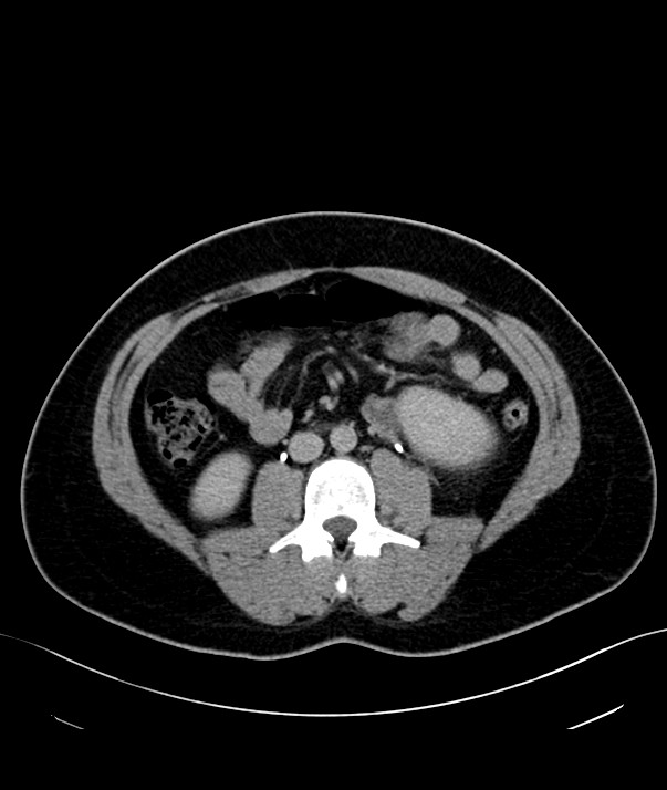 Chromophobe renal cell carcinoma (Radiopaedia 84255-99542 H 24).jpg