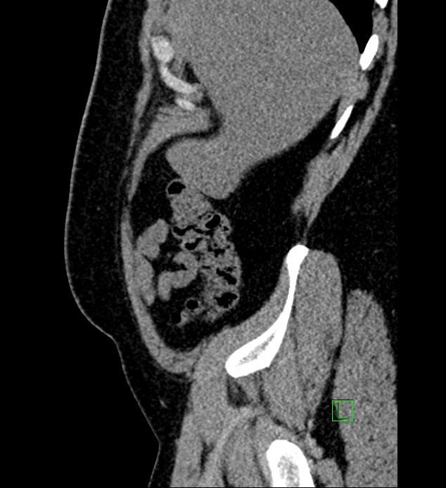 Chromophobe renal cell carcinoma (Radiopaedia 84286-99573 C 163).jpg