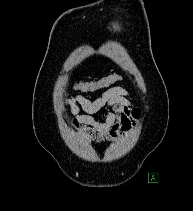 Chromophobe renal cell carcinoma (Radiopaedia 84286-99573 H 18).jpg
