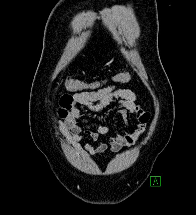 Chromophobe renal cell carcinoma (Radiopaedia 84286-99573 H 25).jpg