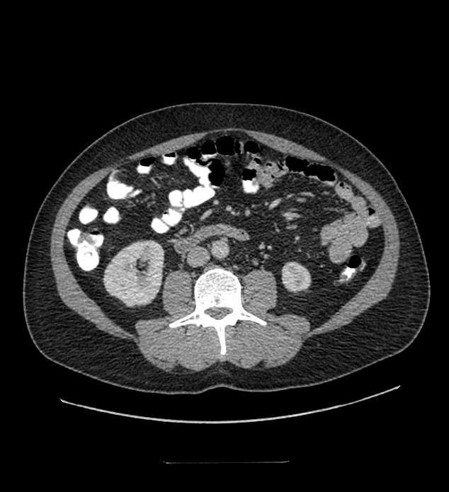 Chromophobe renal cell carcinoma (Radiopaedia 84337-99644 C 68).jpg