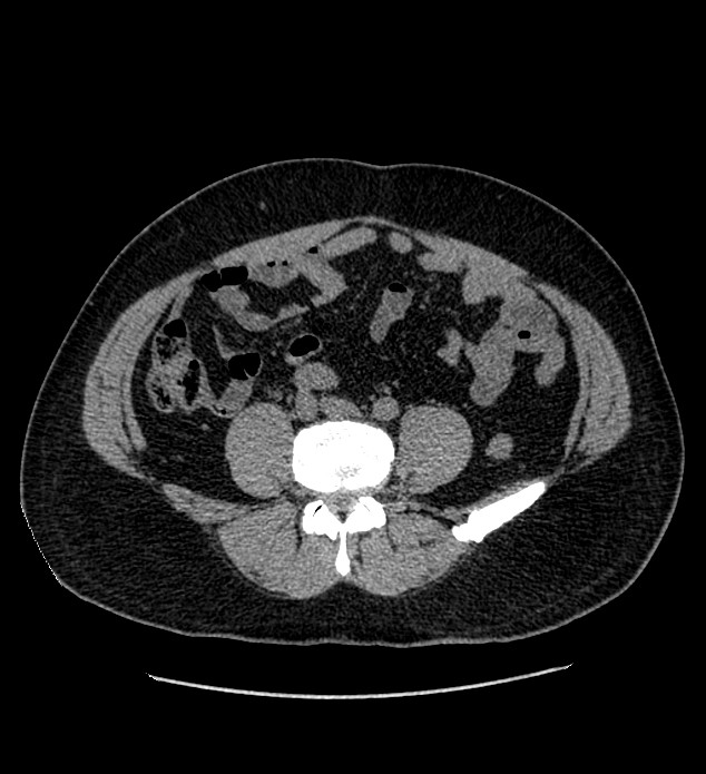 Chromophobe renal cell carcinoma (Radiopaedia 84337-99693 Axial non-contrast 99).jpg