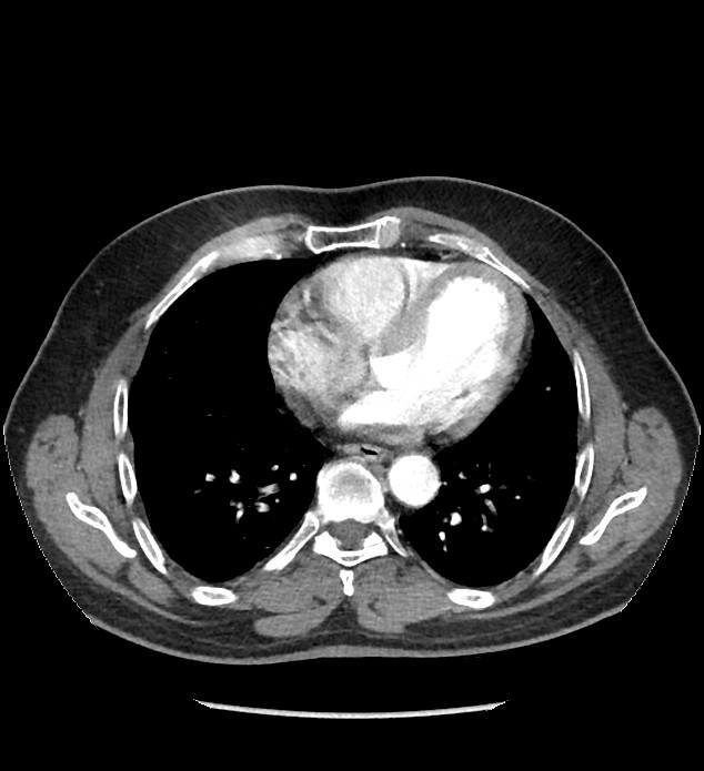 Chromophobe renal cell carcinoma (Radiopaedia 86879-103083 B 1).jpg
