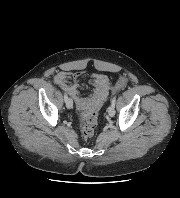 Chromophobe renal cell carcinoma (Radiopaedia 86879-103083 C 131).jpg
