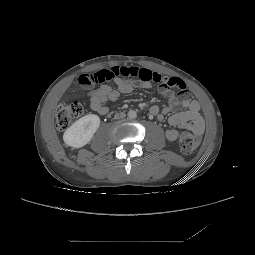File:Chronic IVC thrombosis and resultant IVC filter malposition (Radiopaedia 81158-94800 A 120).jpg