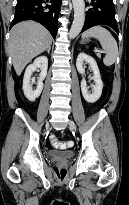 Chronic appendicitis complicated by appendicular abscess, pylephlebitis and liver abscess (Radiopaedia 54483-60700 C 53).jpg