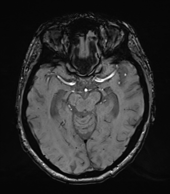 Chronic hypertensive encephalopathy (Radiopaedia 39993-42482 Axial SWI 35).png