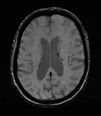 Chronic hypertensive encephalopathy (Radiopaedia 39993-42482 Axial SWI 54).png