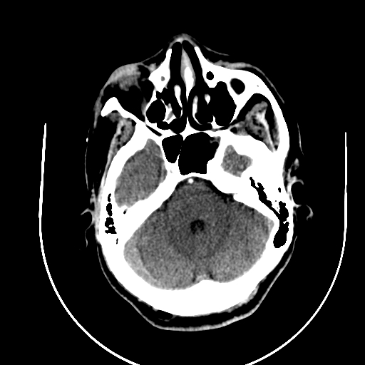 File:Chronic invasive fungal sinusitis (Radiopaedia 91563-109286 B 24).jpg