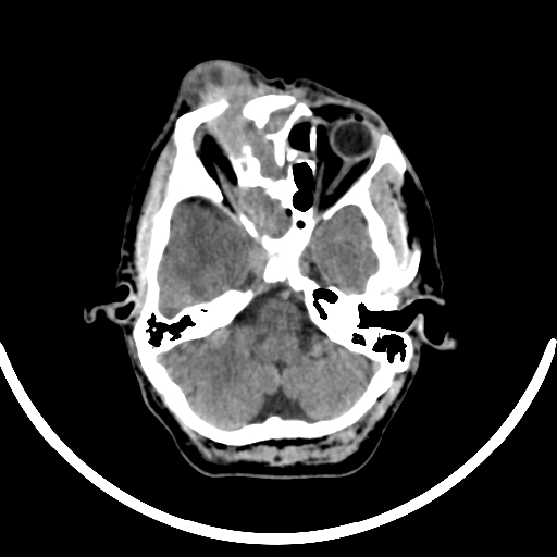 Chronic invasive fungal sinusitis with intraorbital and intracranial extension (Radiopaedia 56387-63046 Axial non-contrast 130).jpg