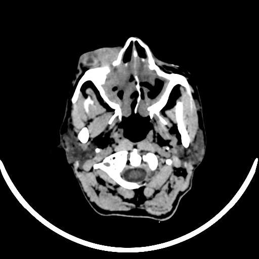 File:Chronic invasive fungal sinusitis with intraorbital and intracranial extension (Radiopaedia 56387-63046 Axial non-contrast 63).jpg