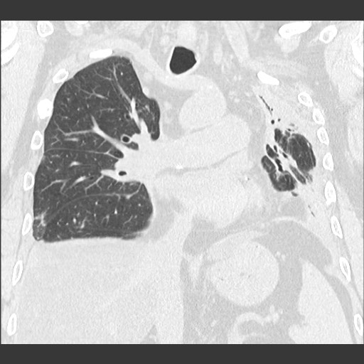 Chronic lung allograft dysfunction - restrictive form (Radiopaedia 60595-68316 Coronal lung window 55).jpg