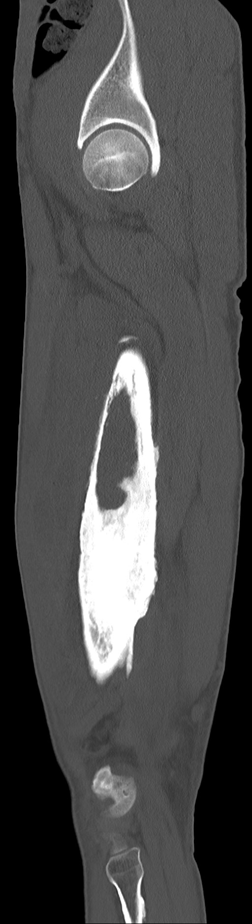 Chronic osteomyelitis (with sequestrum) (Radiopaedia 74813-85822 C 84).jpg