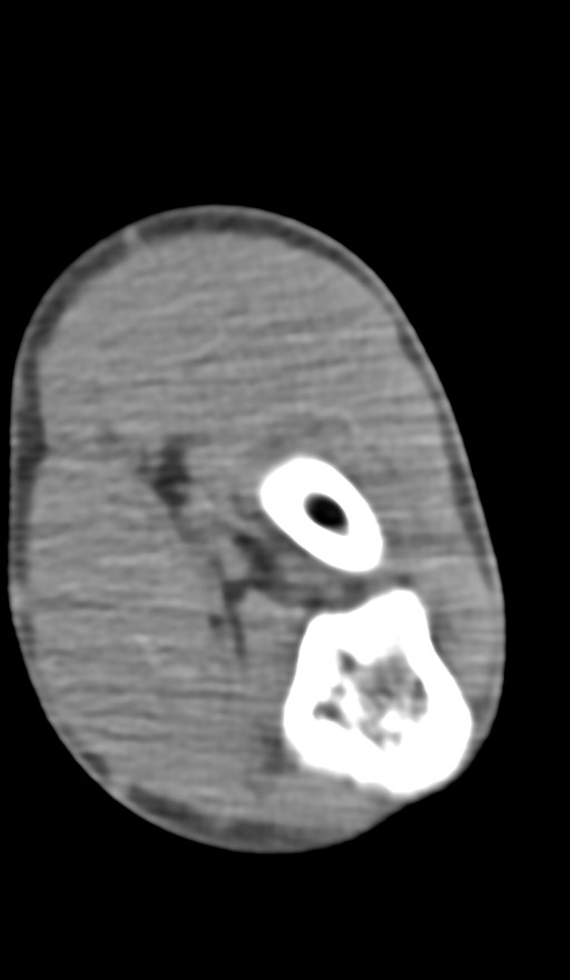 Chronic osteomyelitis of the distal humerus (Radiopaedia 78351-90971 Axial non-contrast 106).jpg