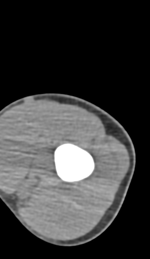 Chronic osteomyelitis of the distal humerus (Radiopaedia 78351-90971 Axial non-contrast 46).jpg